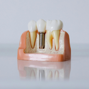 Enhance Your Smile and Confidence with Dental Implants in Ramsey